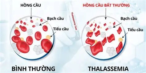  Chế độ ăn cho người bệnh Thalassemia 