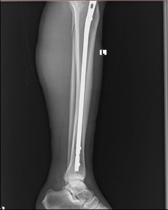  Đột phá mới trong điều trị gãy xương cẳng chân tại Bệnh viện Đa khoa Hòa Bình Kỹ thuật đóng đinh nội tủy có chốt ngang dưới màn tăng sáng – Ít xâm lấn, hiệu quả vượt trội