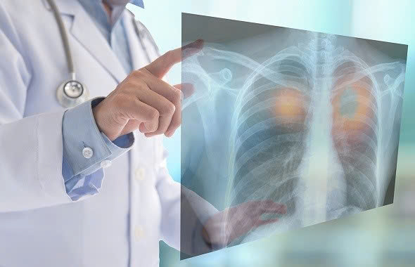  Khám phá gói dịch vụ chẩn đoán ung thư phổi tại Bệnh viện Đa khoa tỉnh Hòa Bình
